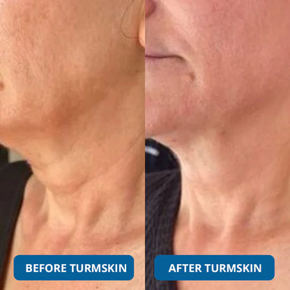 🏆LAST DAY BUY 1 GET 1 FREE⚡3% Hyaluronic Acid Ultra Hydrating Serum by TurmSkin